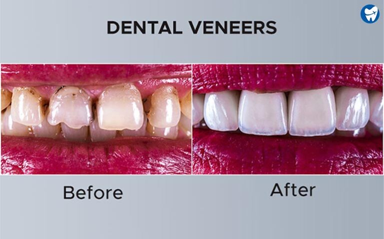 Dental Veneers Abroad | Best Countries For Cheapest Veneers