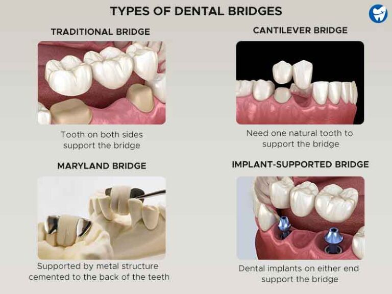 Affordable Dental Bridge Abroad | Tooth-Colored Fixed Teeth Caps