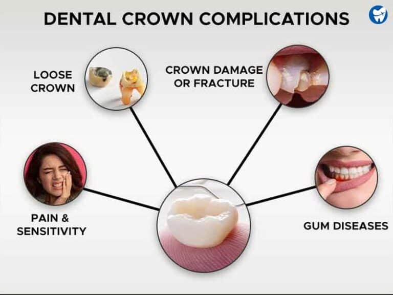 Dental Crown Aftercare Instructions: Cleaning, Tips & FAQs (2021)