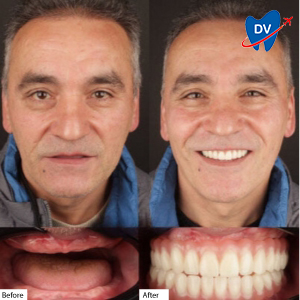 Before and after full mouth implants in Turkey