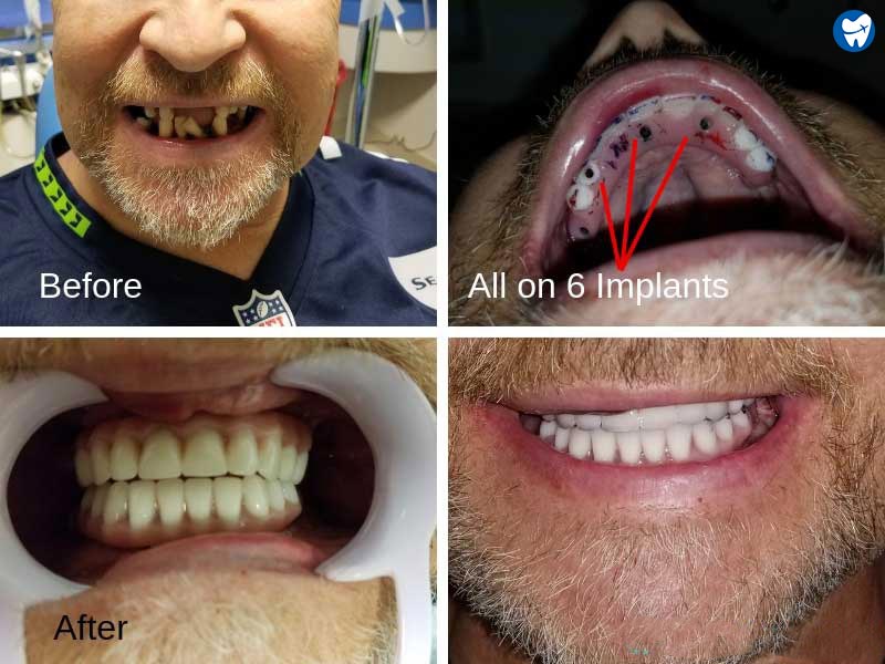 All-on-6 Implants: Before and After