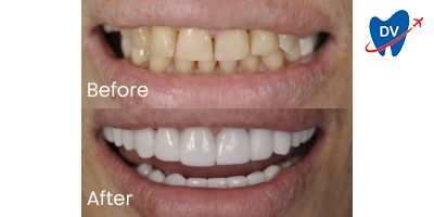 14+ Teeth Whitening Quotes