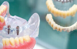 Implant-supported Restorations