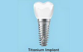 Titanium Implants