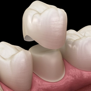 dental crown animation image