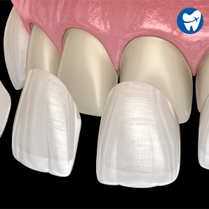 Dental veneers animated image