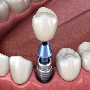 Dental implant animation image