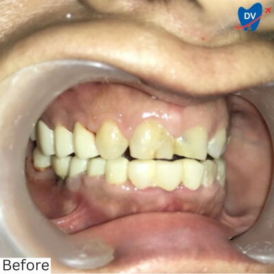 Dental Veneers Panchkula - Before