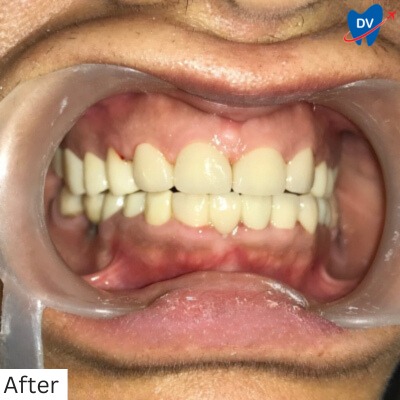 Dental Veneers Panchkula - After