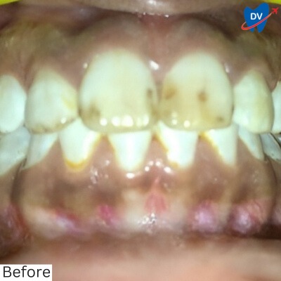 Dental Crowns Panchkula - Before