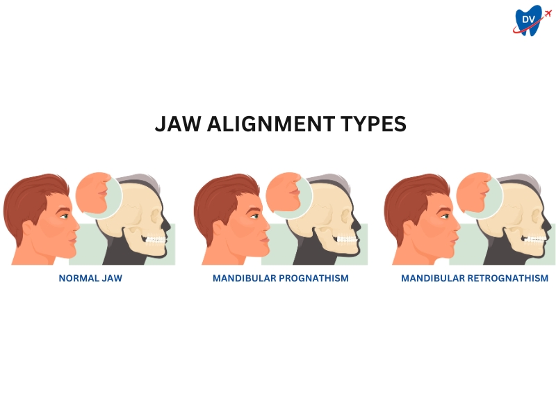 Jaw Alignment Types 