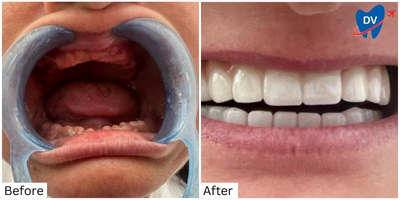 Dental Work in Didim, Turkey: Before and After