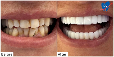 Dental Work in Didim, Turkey: Before and after