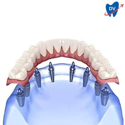 All-on-8 dental implant