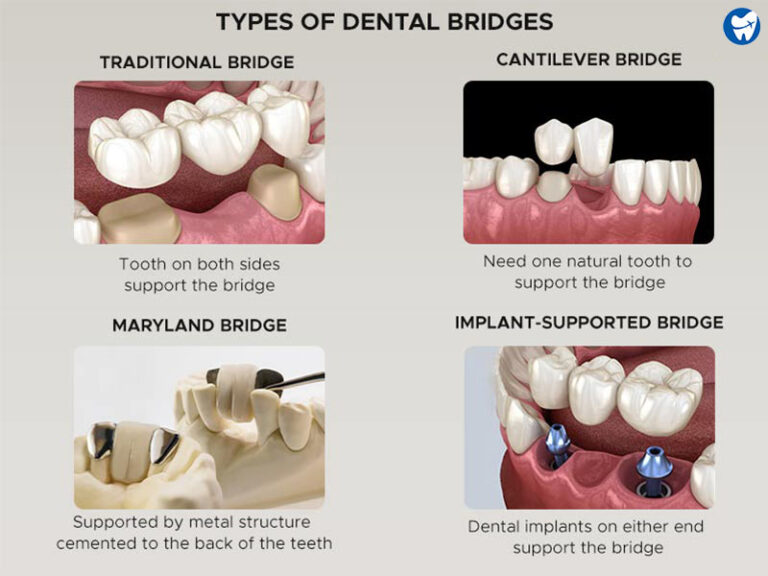 Dental Crowns Cost With Without Insurance Types Procedure Benefits