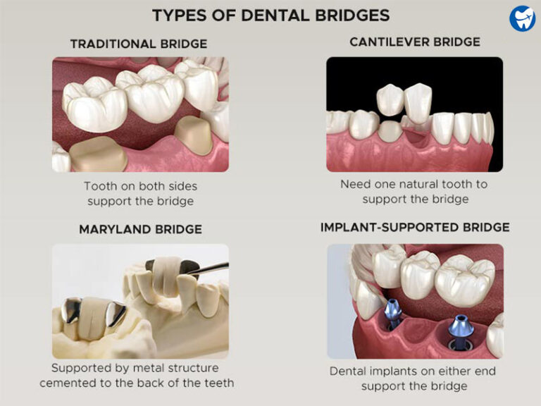 Dental Crowns: Cost (With-Without Insurance), Types, Procedure, Benefits