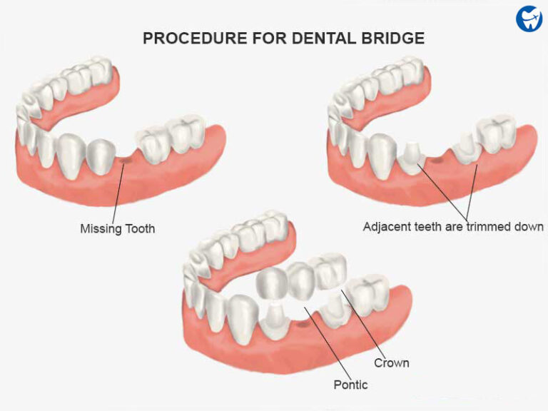 Affordable Dental Bridge Abroad | Tooth-Colored Fixed Teeth Caps